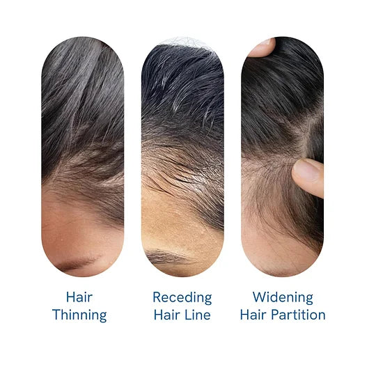 (New Formula)Advanced Hair Growth Roll-On Serum | Men & Women ⭐⭐Final 4 Hours: Second Item for Only $5! 🔥