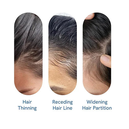 (New Formula)Advanced Hair Growth Roll-On Serum | Men & Women ⭐⭐Final 4 Hours: Second Item for Only $5! 🔥