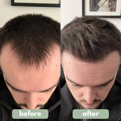 (New Formula)Advanced Hair Growth Roll-On Serum | Men & Women ⭐⭐Final 4 Hours: Second Item for Only $5! 🔥